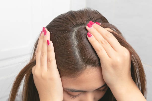 Dandruff ? Symptoms, Causes, Diagnosis, Treatment, and Prevention