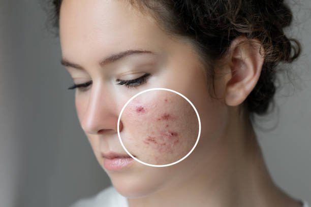 Everything You Want to Know About Acne