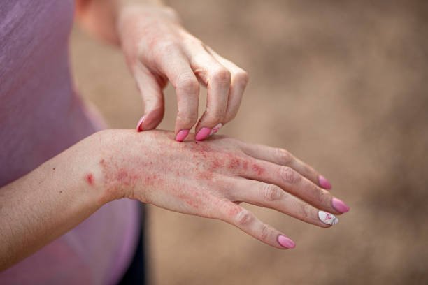 Everything You Need to Know About Psoriasis