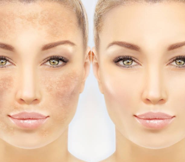 Hyperpigmentation