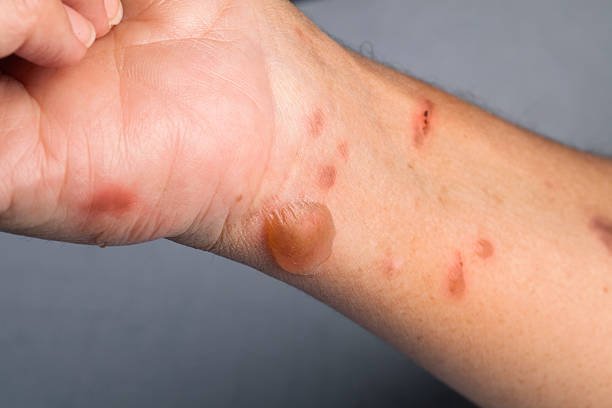 How to get rid of burn marks: Home remedies