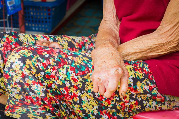 Leprosy: Causes, Symptoms, and Treatment