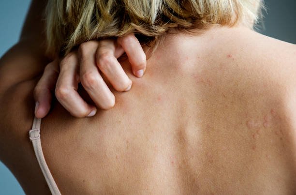 Natural Home Remedies for Itchy Skin